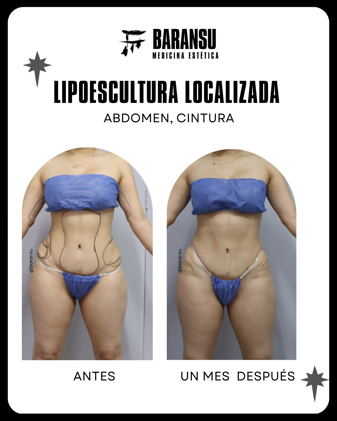 blefaroplastia 20