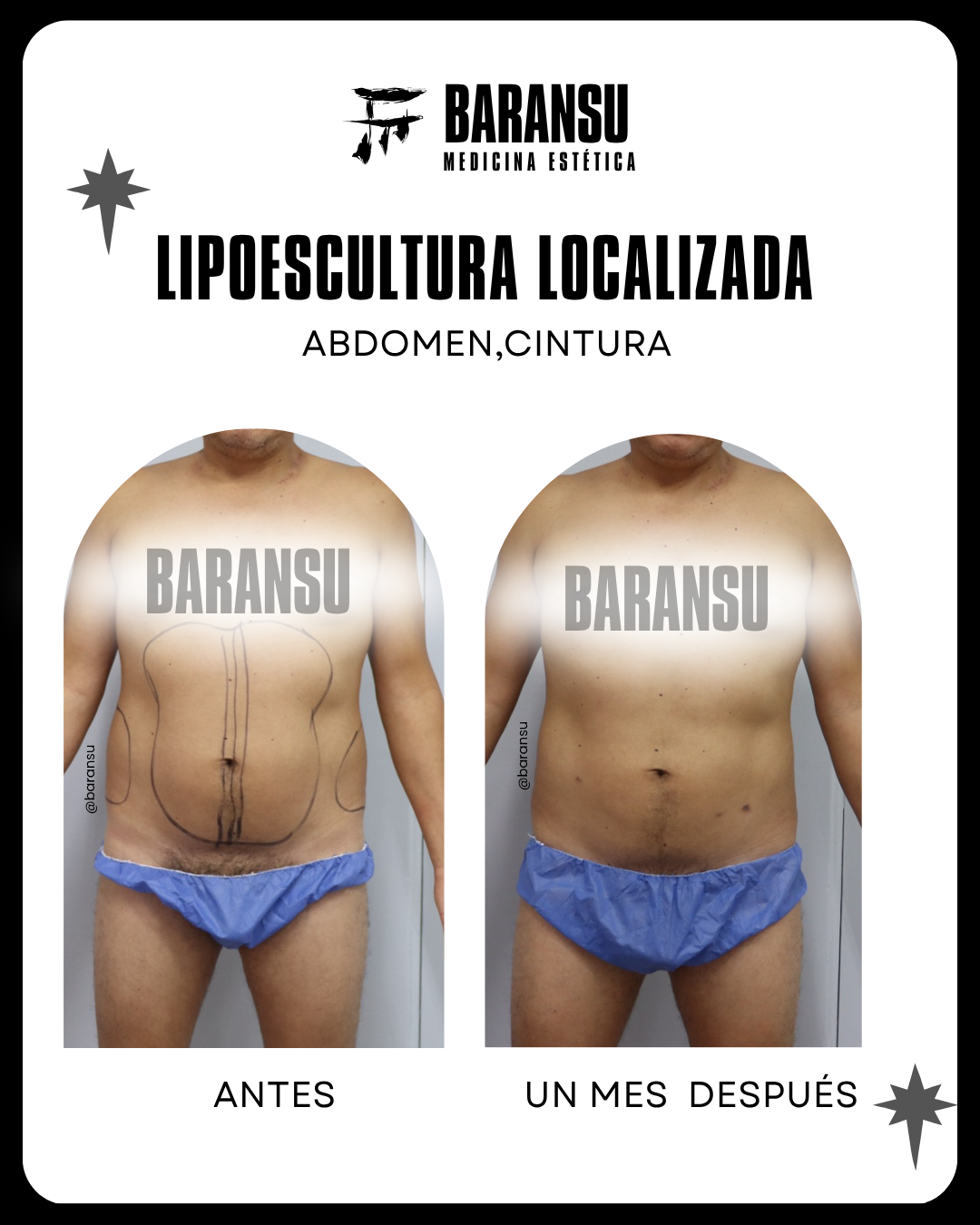 blefaroplastia 21