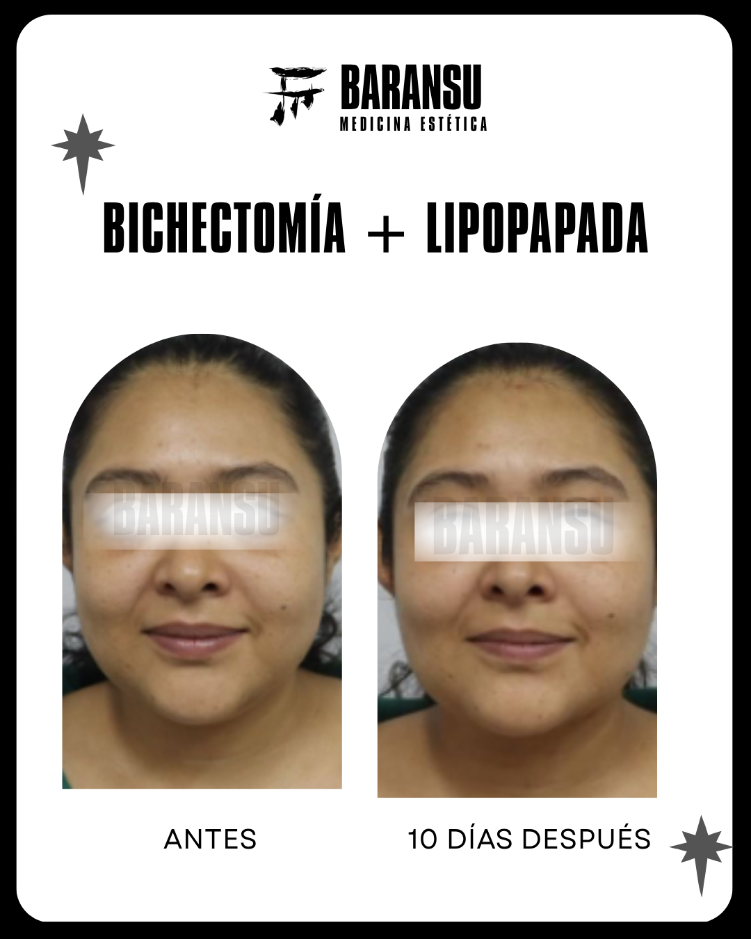 lipo de papada 28