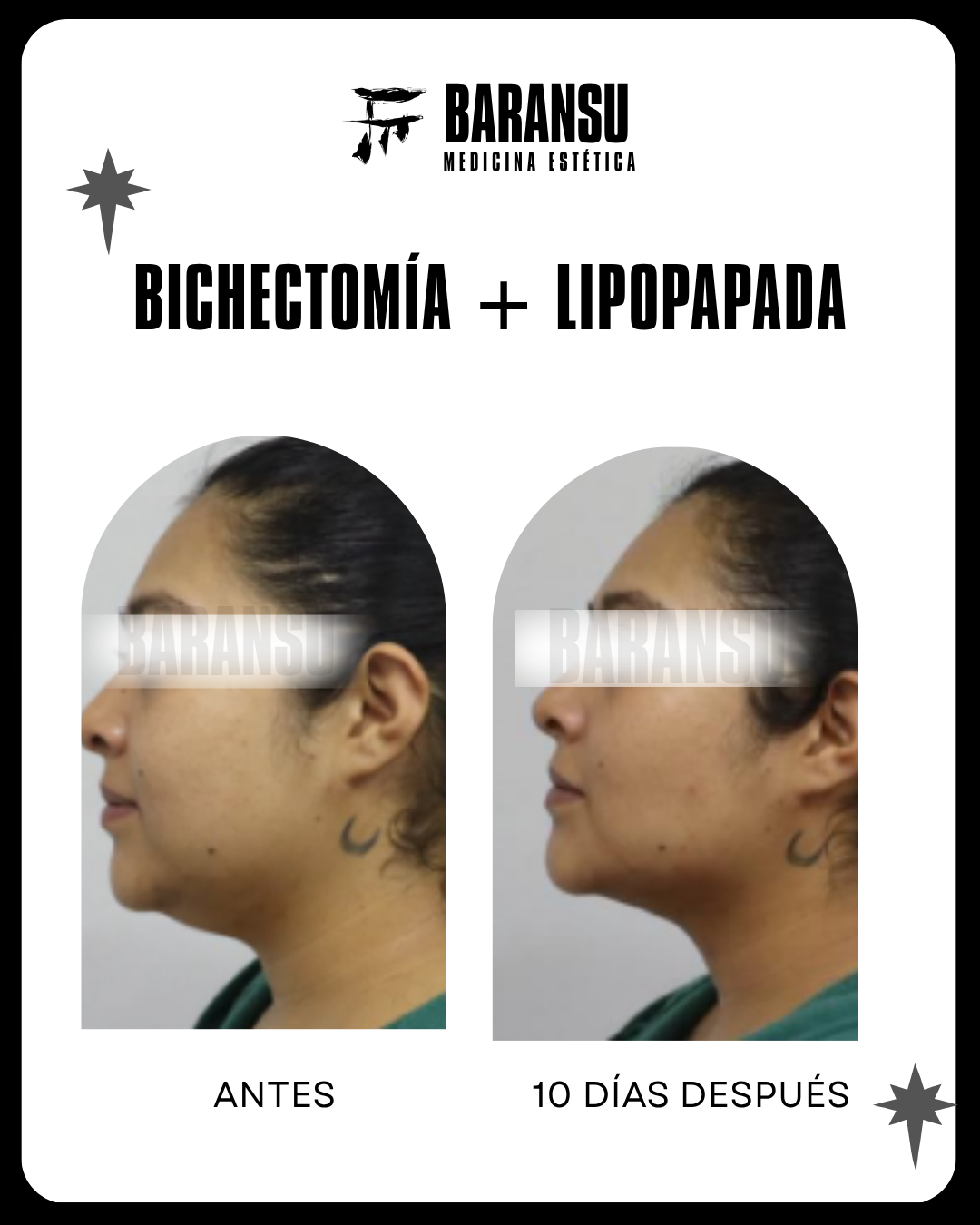 lipo de papada 29