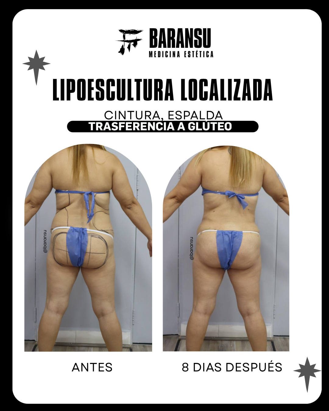lipoescultura localizada (minilipo) 21