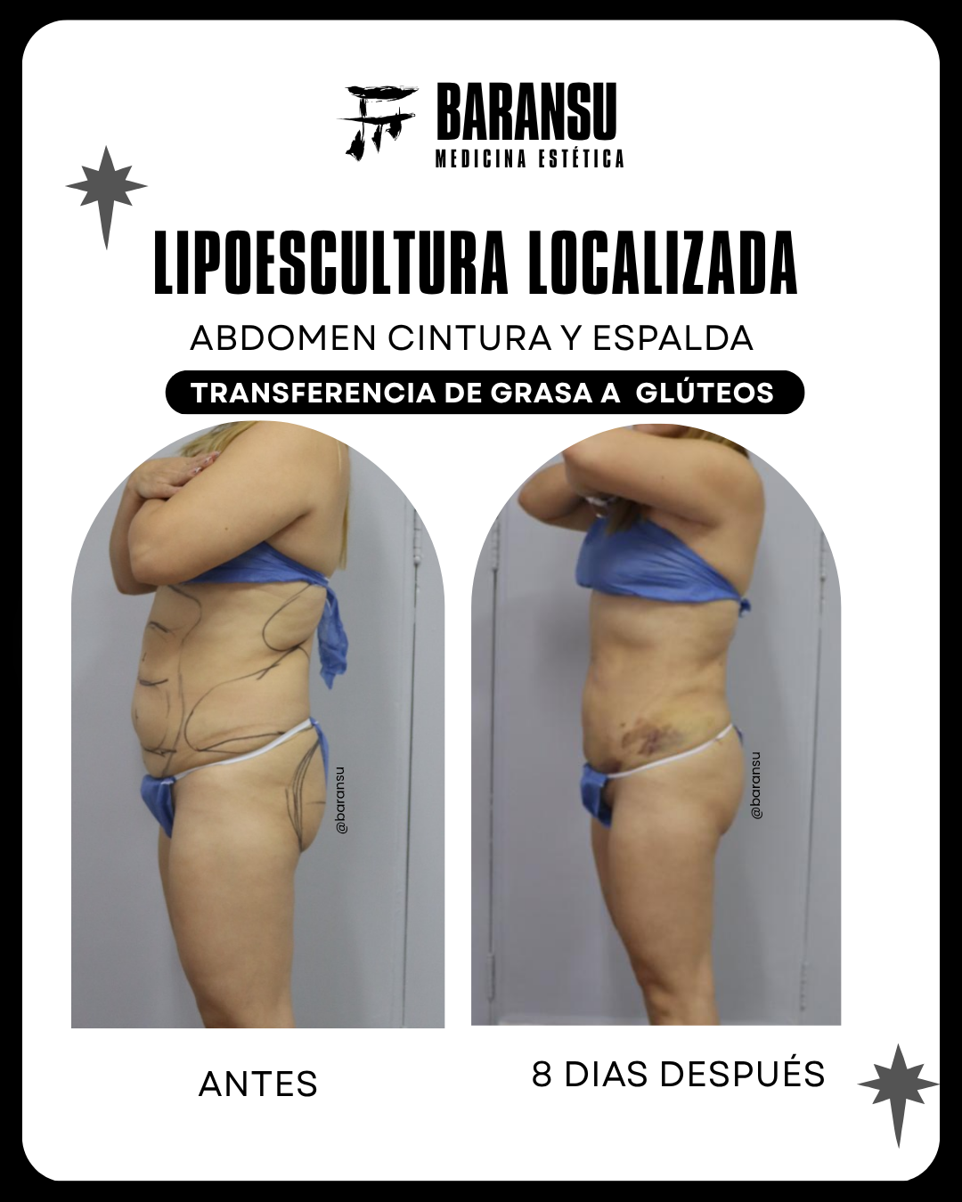 lipo de papada 30