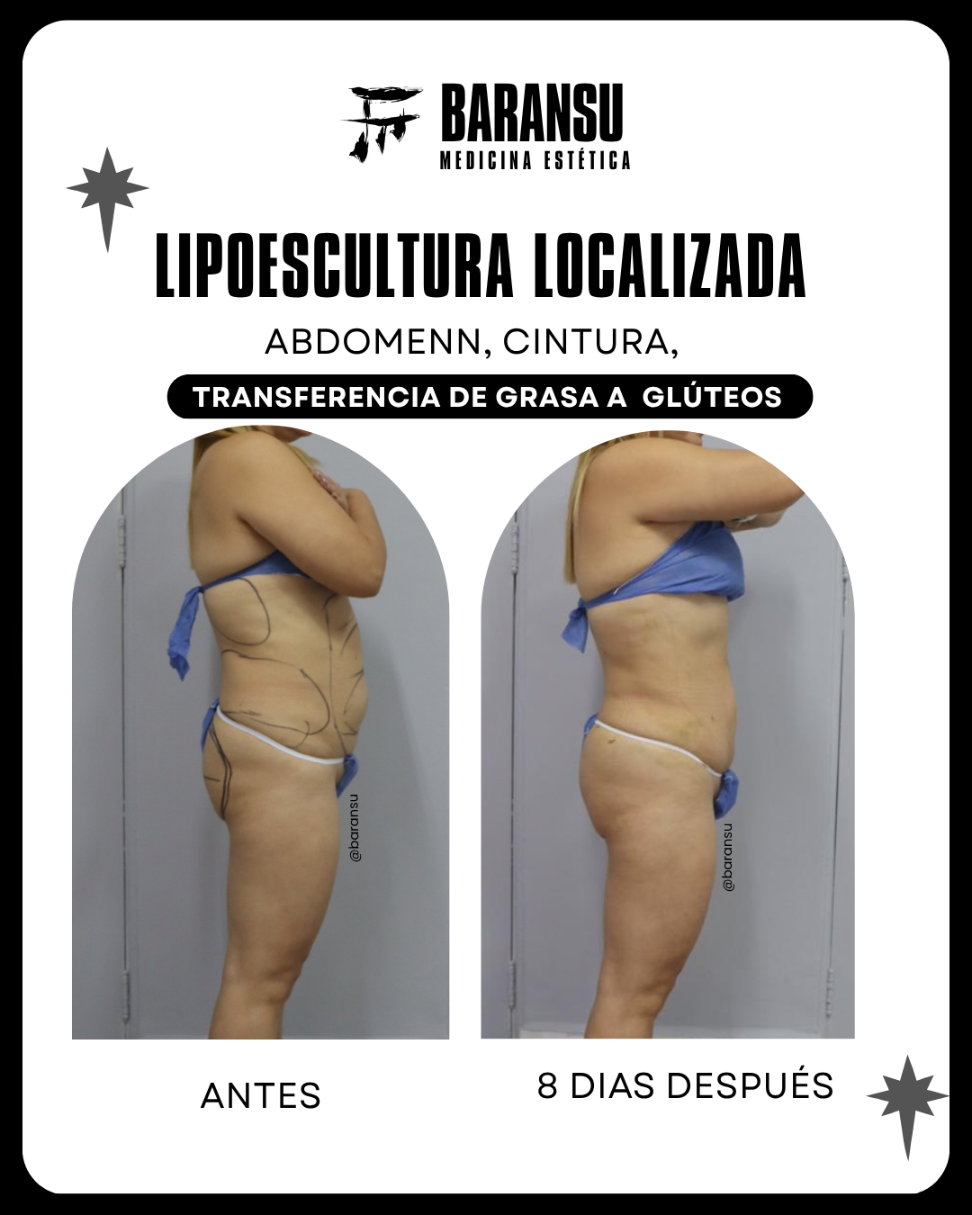 lipo de papada 31