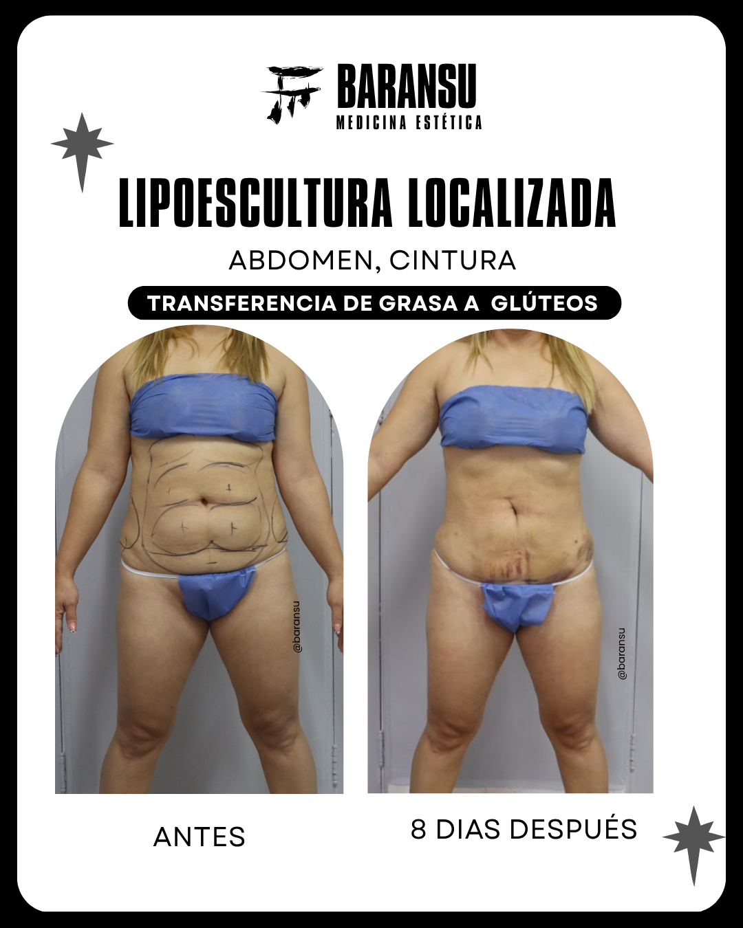 lipo de papada 32