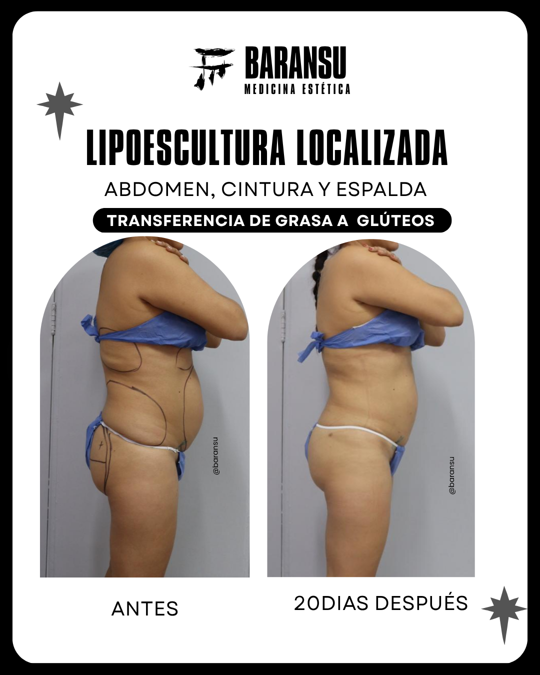lipo de papada 33