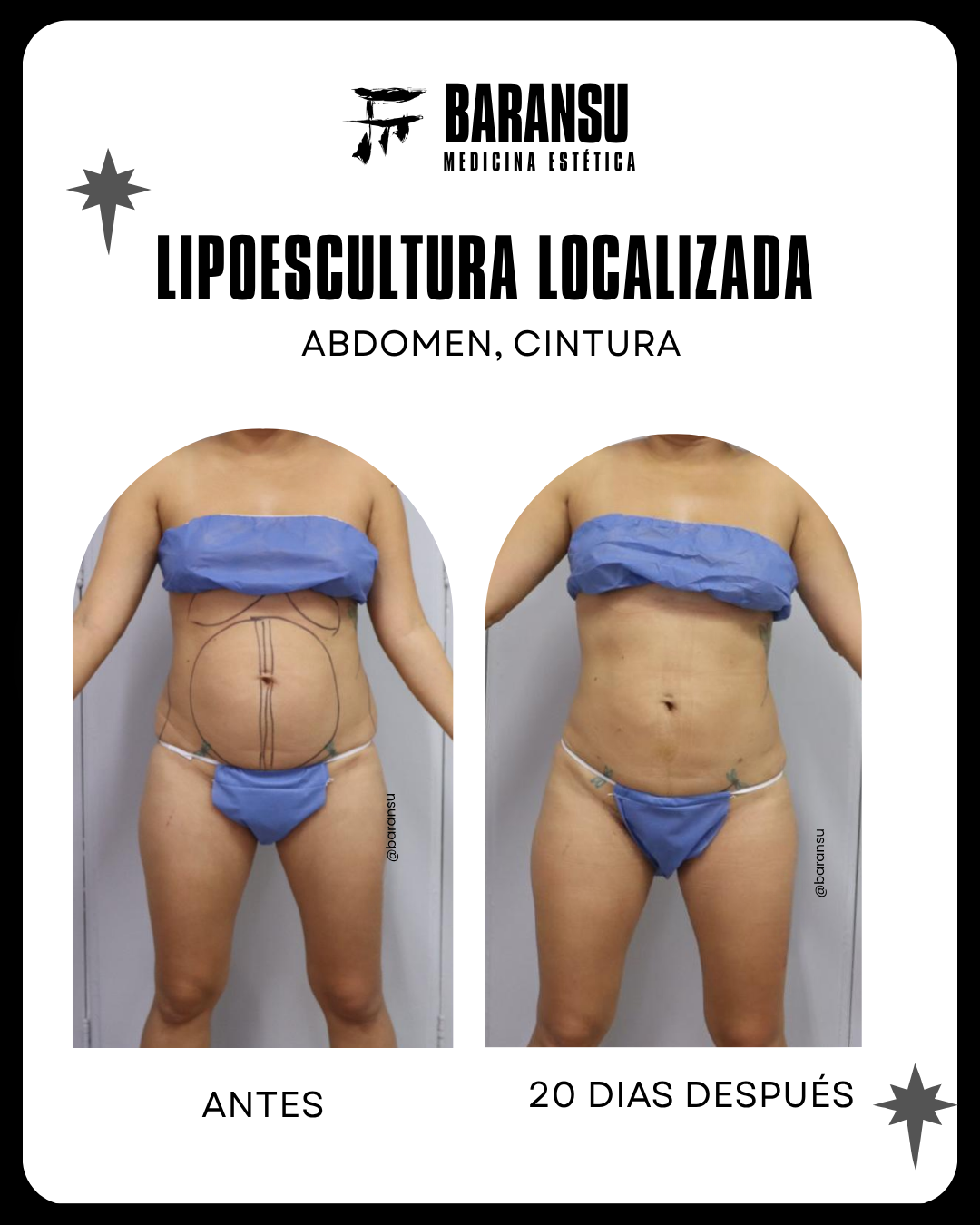 lipoescultura localizada (minilipo) 26