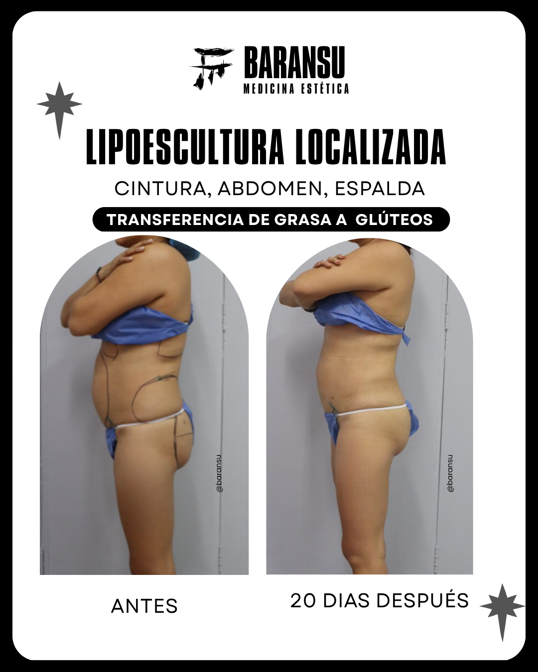 lipoescultura localizada (minilipo) 27