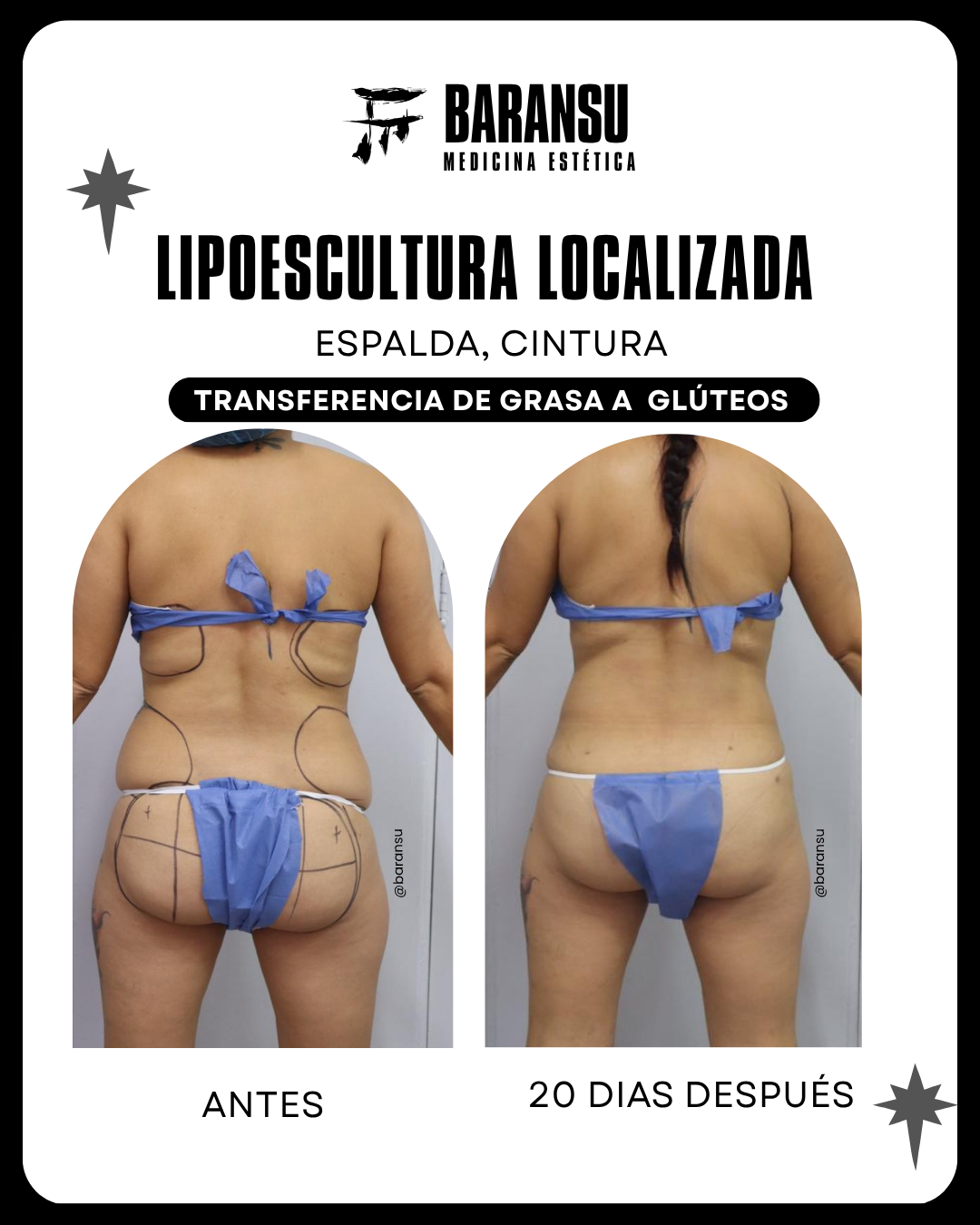 lipoescultura localizada (minilipo) 28