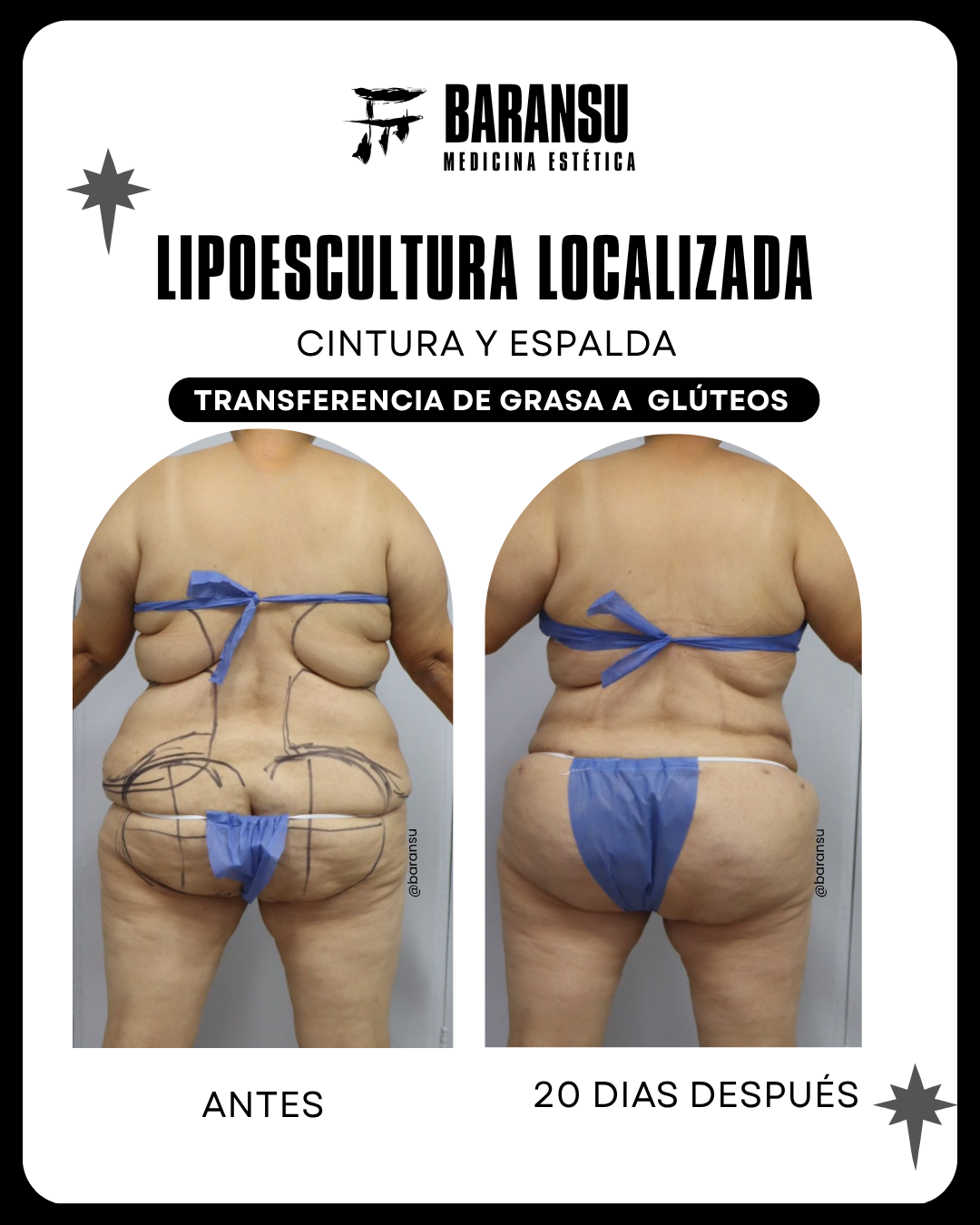 lipoescultura localizada (minilipo) 29