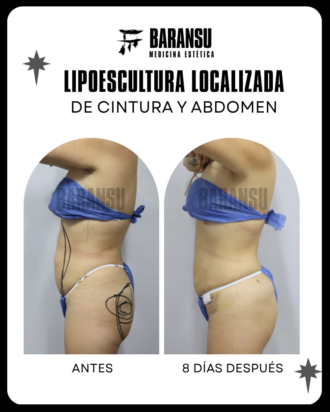 lipoescultura localizada (minilipo) 30