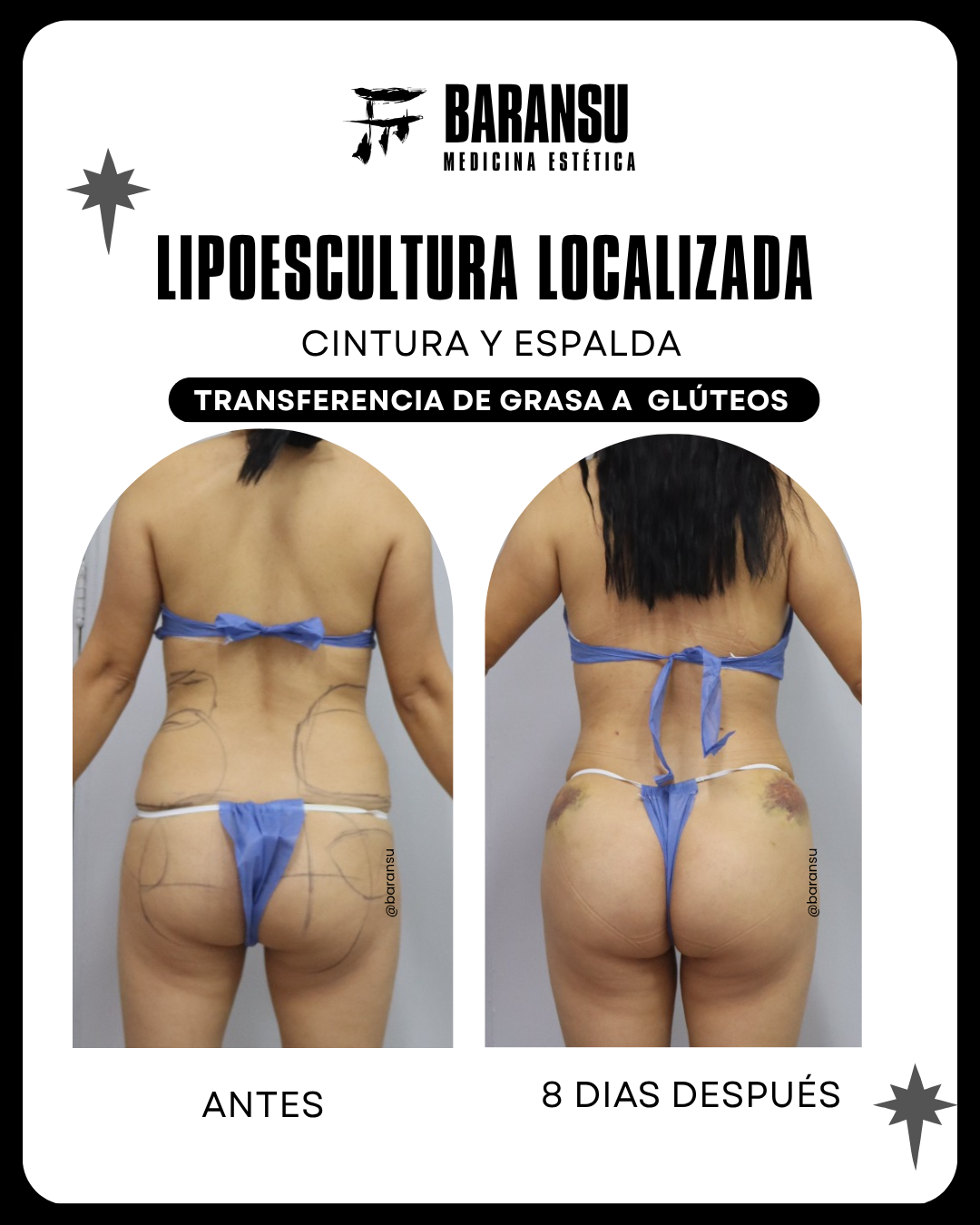 lipoescultura localizada (minilipo) 31
