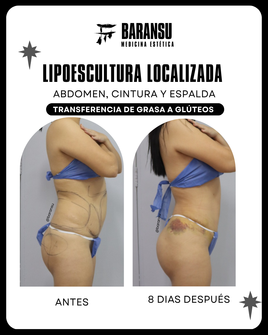 lipoescultura localizada (minilipo) 33