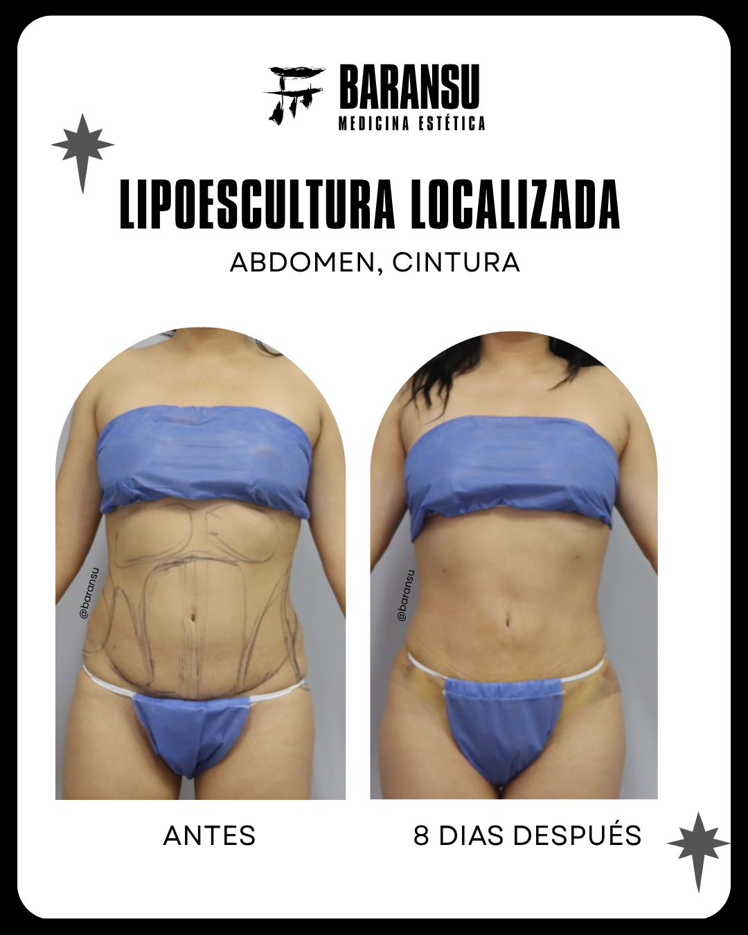 lipoescultura localizada (minilipo) 34
