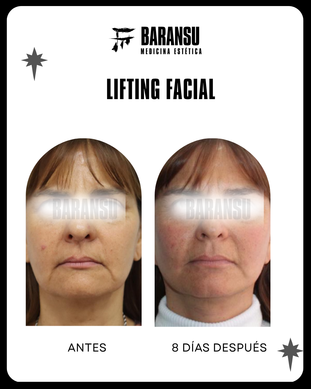 blefaroplastia 22