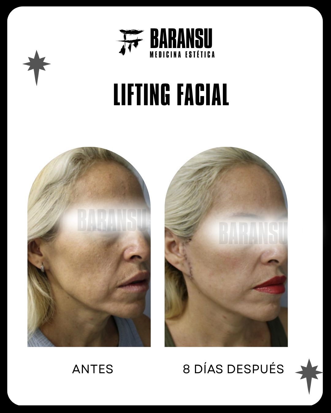 lifting facial 19
