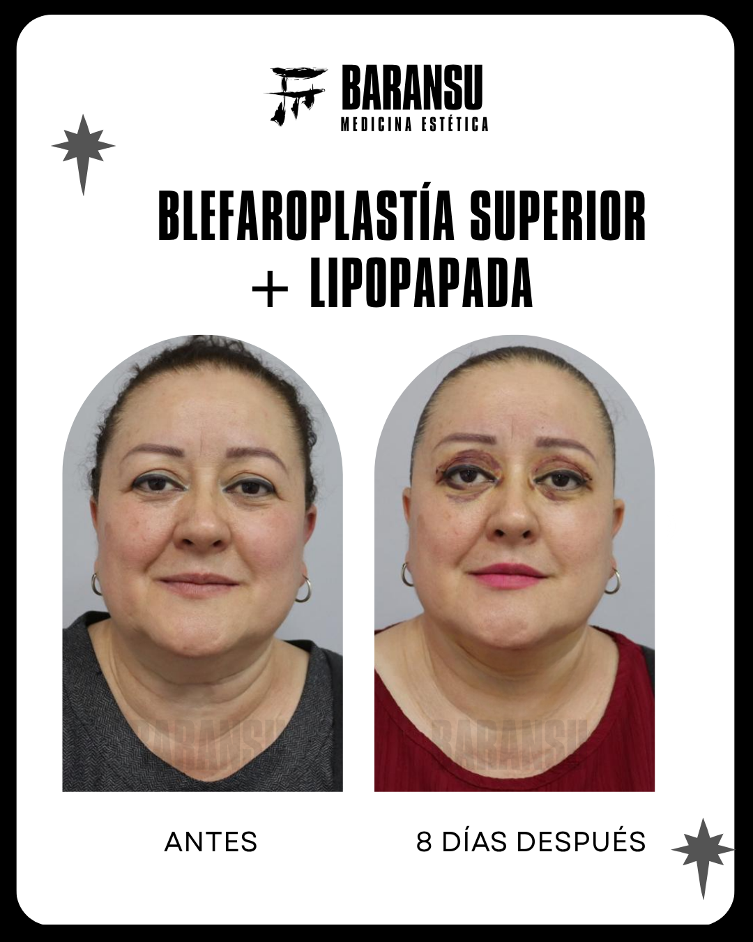 blefaroplastia 23