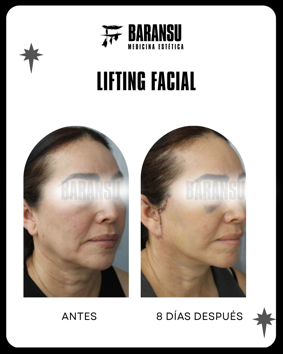 blefaroplastia 24