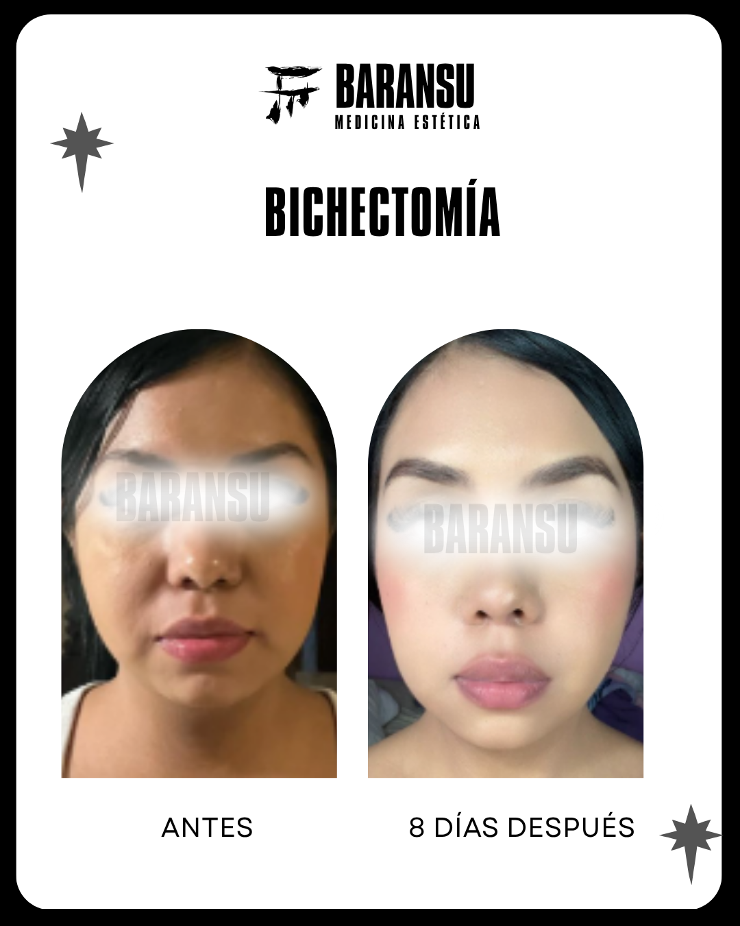 bichectomia 16