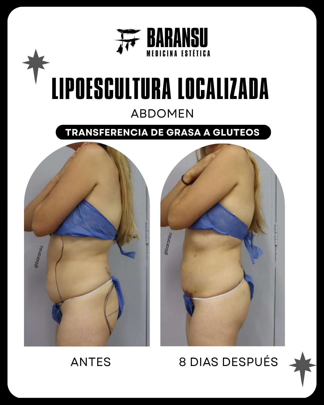 lipo de papada 35