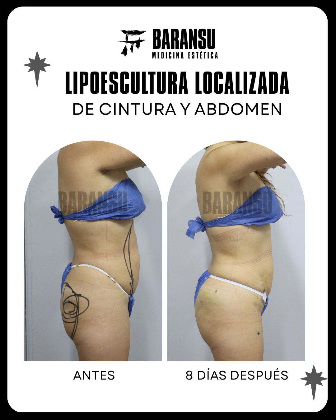 lipoescultura localizada (minilipo) 36