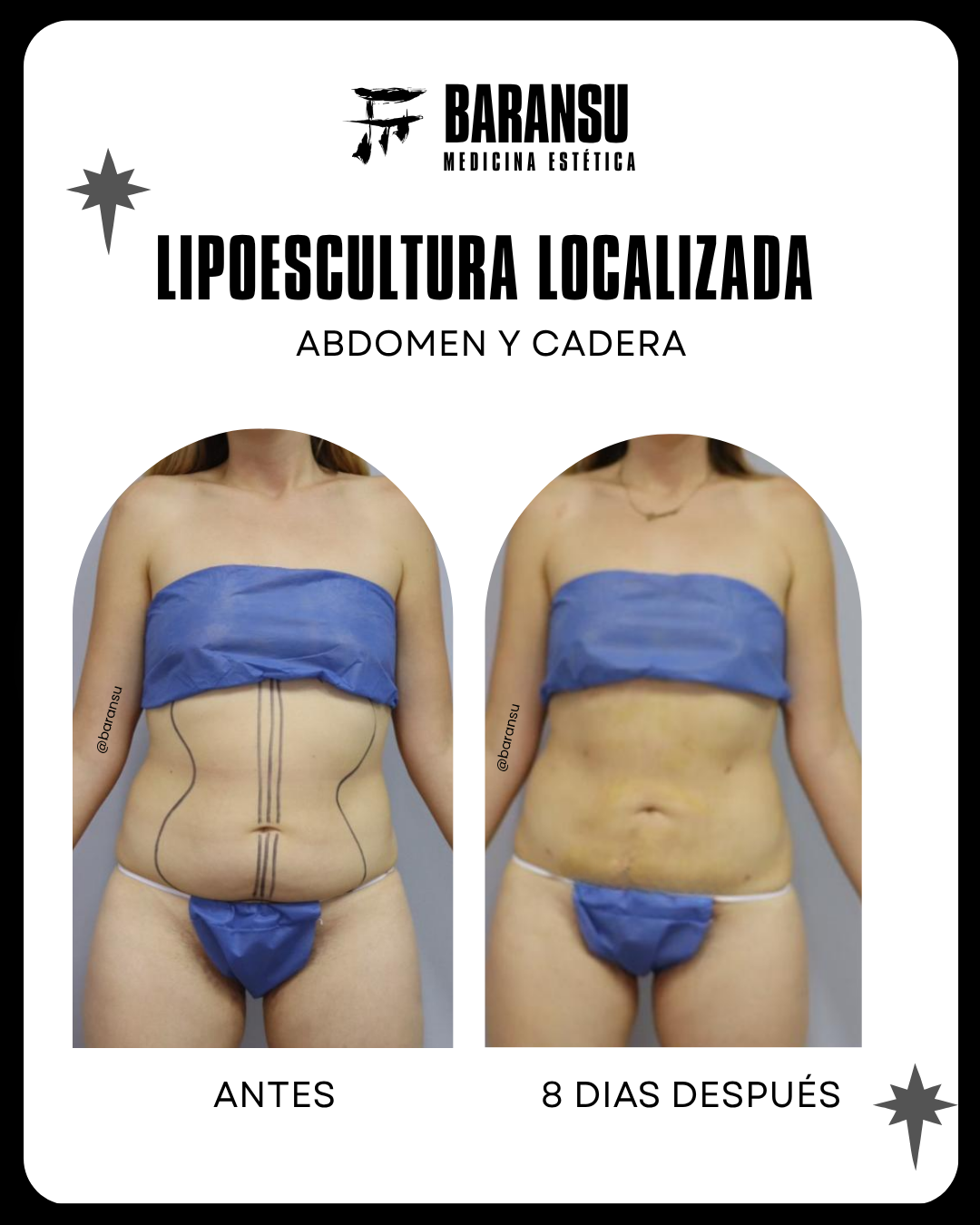 lipo de papada 36