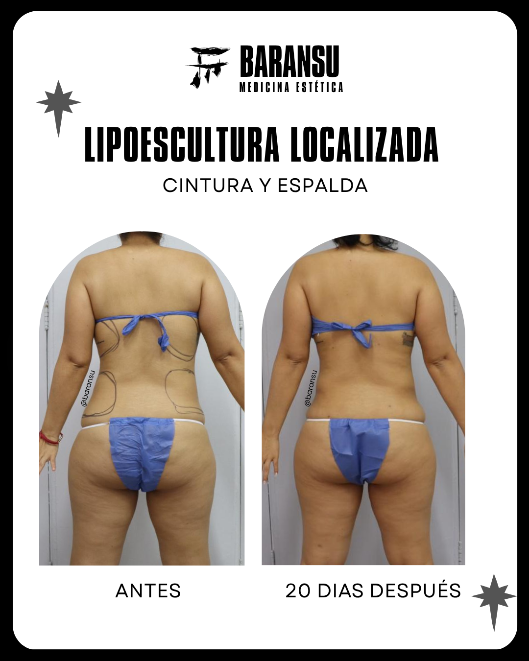 lipo de papada 37