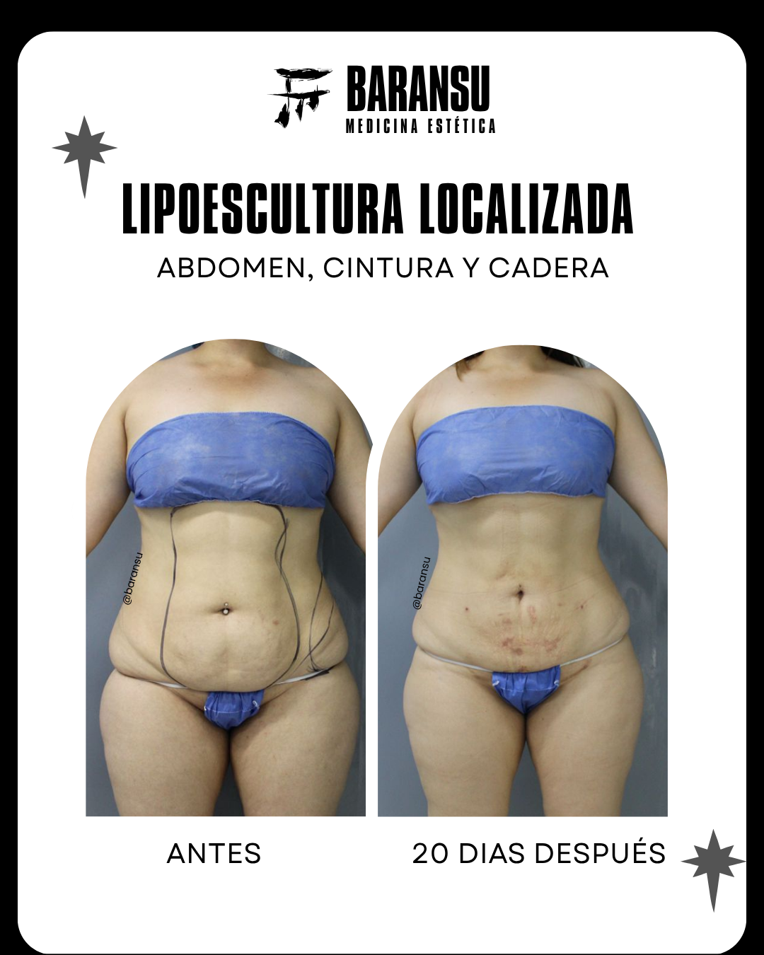lipoescultura localizada (minilipo) 40
