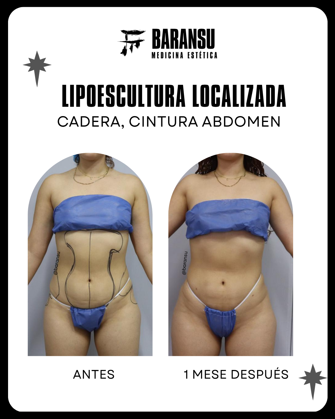 lipoescultura localizada (minilipo) 44
