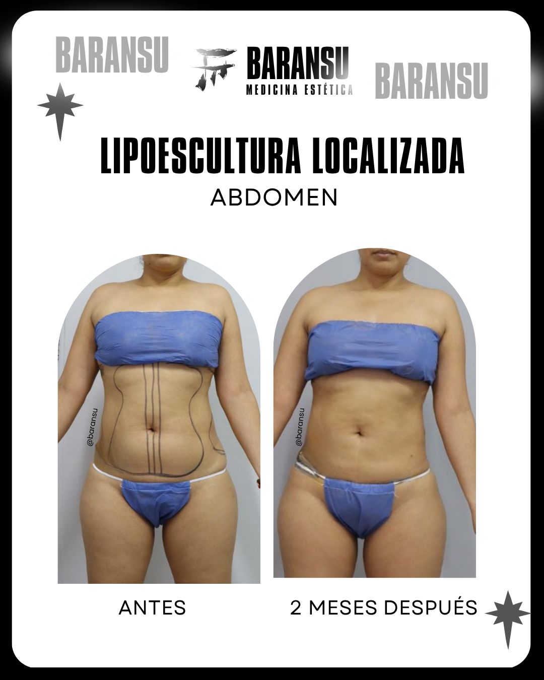 lipoescultura localizada (minilipo) 45
