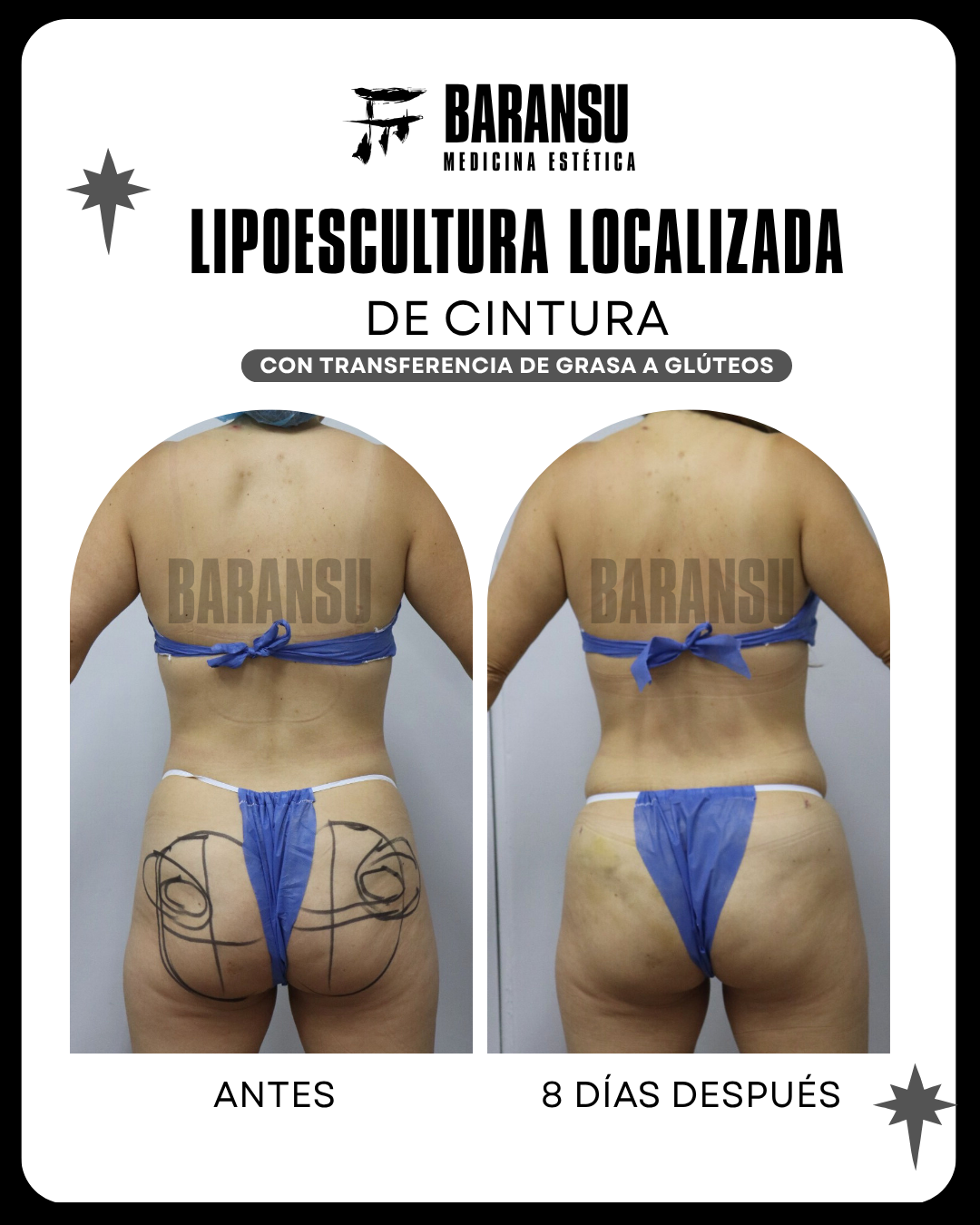 lipoescultura localizada (minilipo) 46