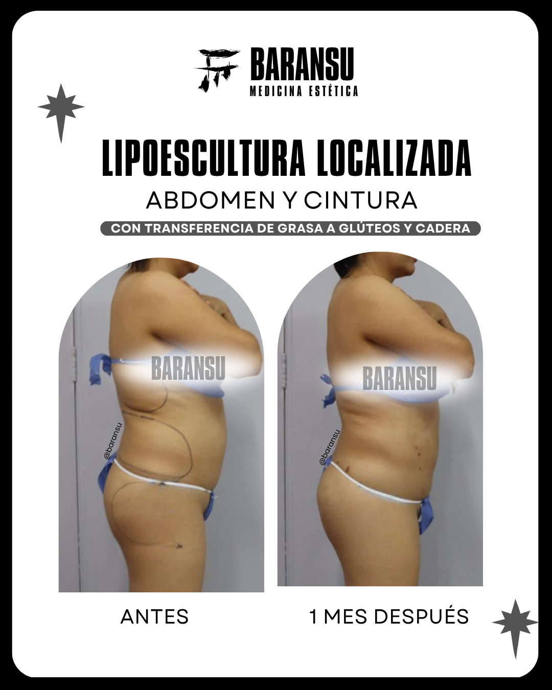 lipoescultura localizada (minilipo) 48