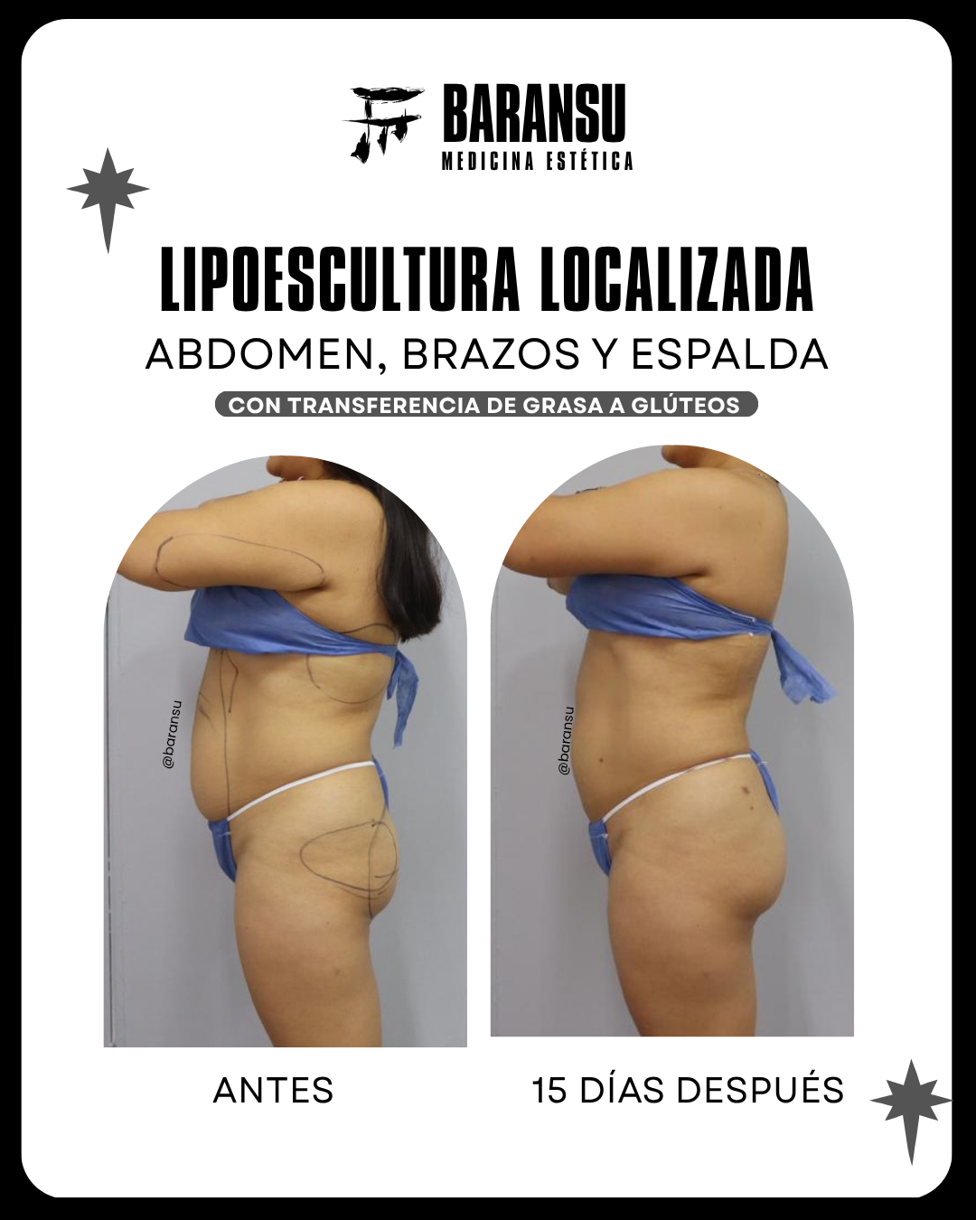 lipoescultura localizada (minilipo) 50