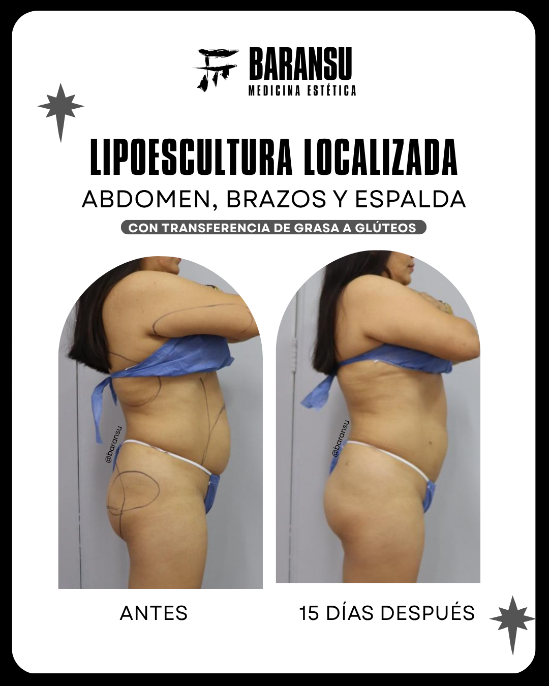 lipoescultura localizada (minilipo) 51