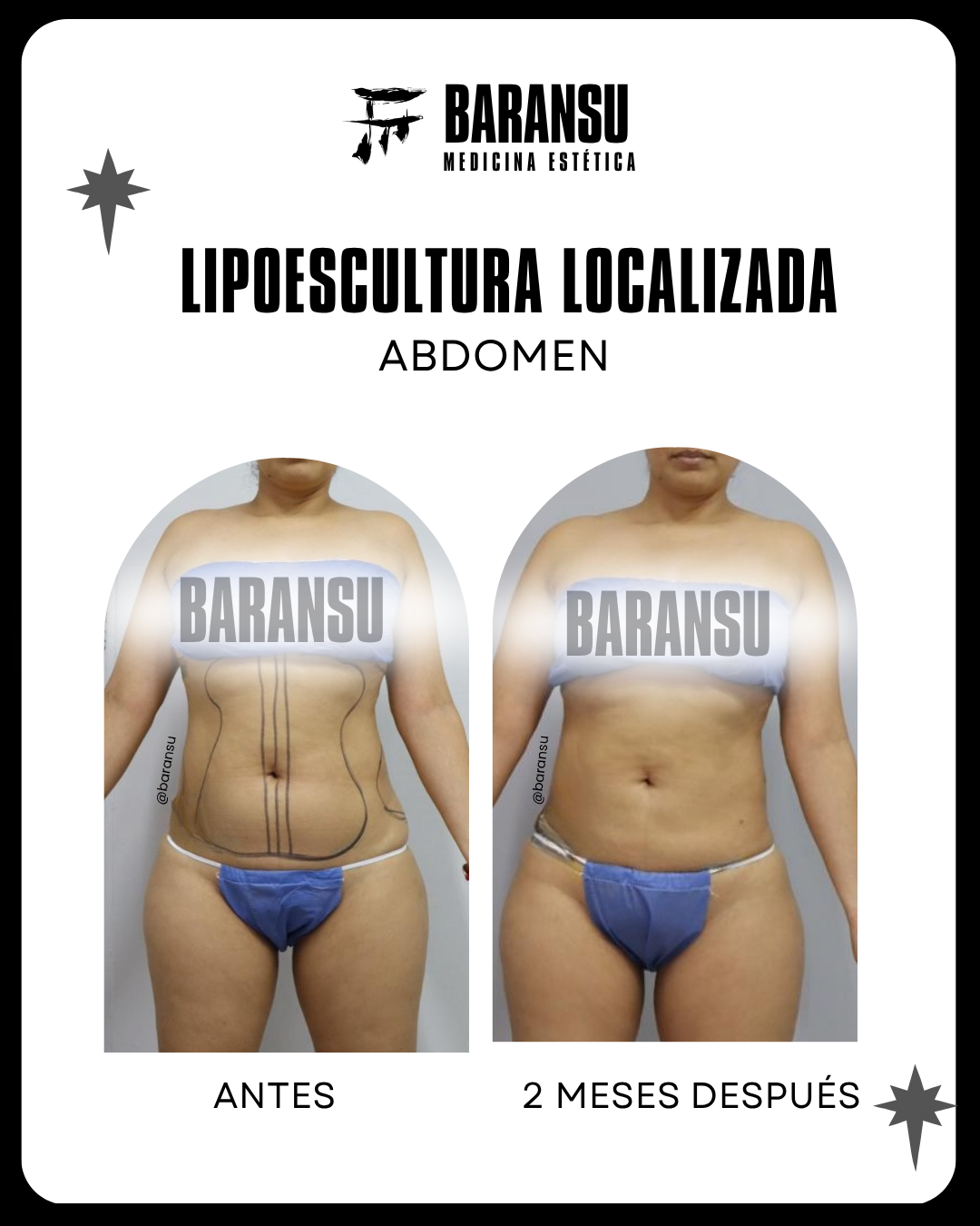 lipoescultura localizada (minilipo) 52