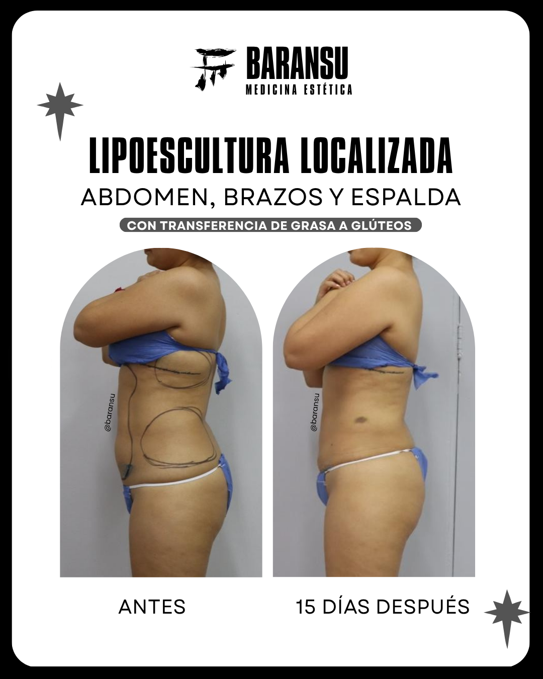 lipoescultura localizada (minilipo) 53