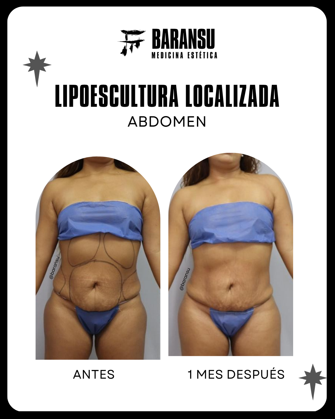 lipoescultura localizada (minilipo) 54