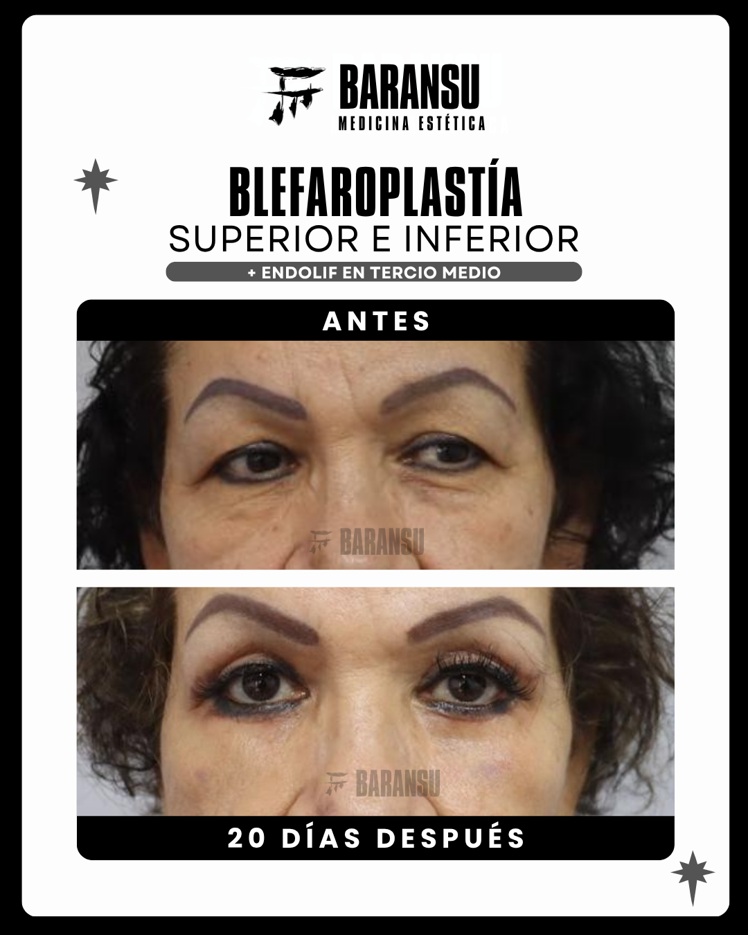 blefaroplastia 25