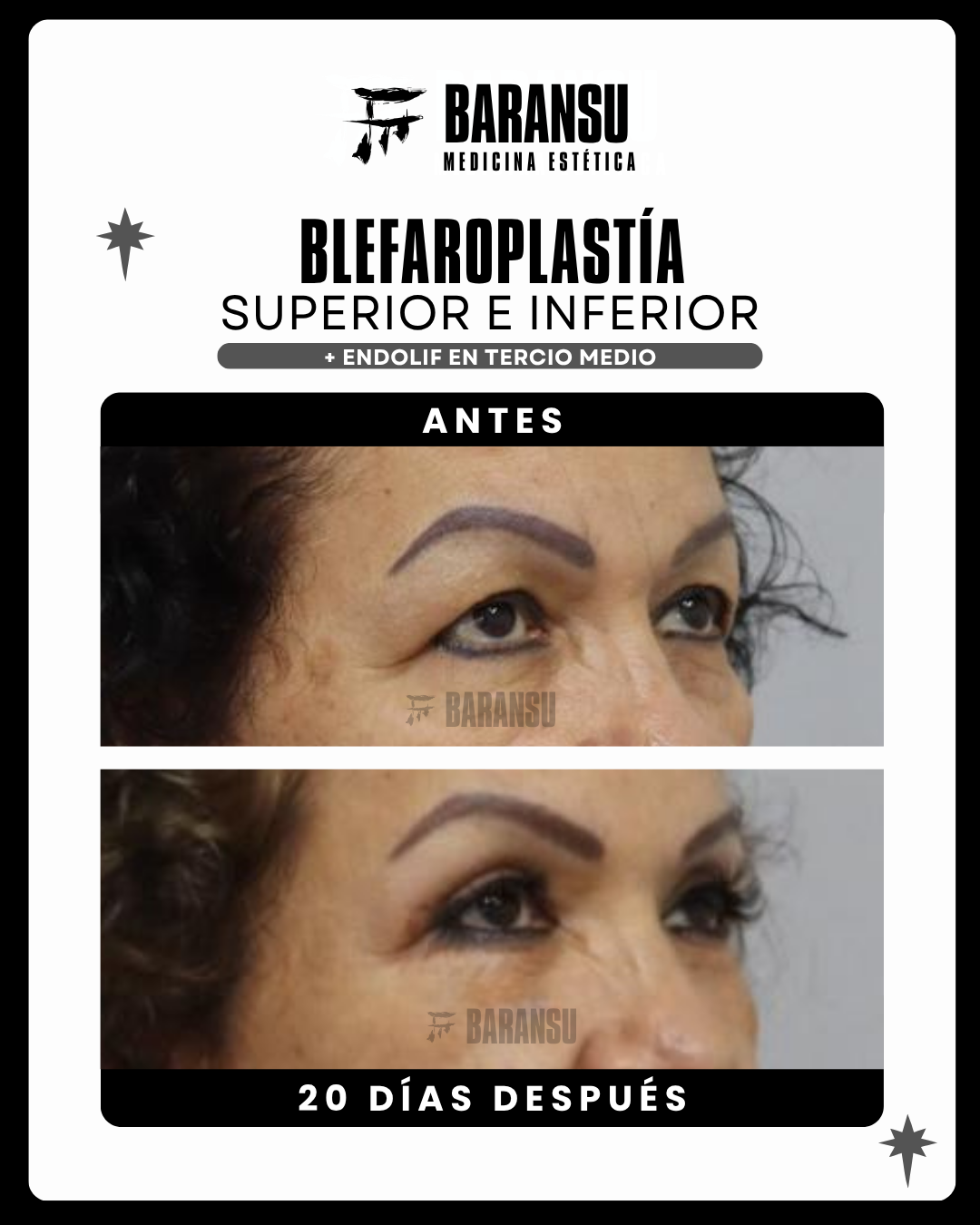 blefaroplastia 26