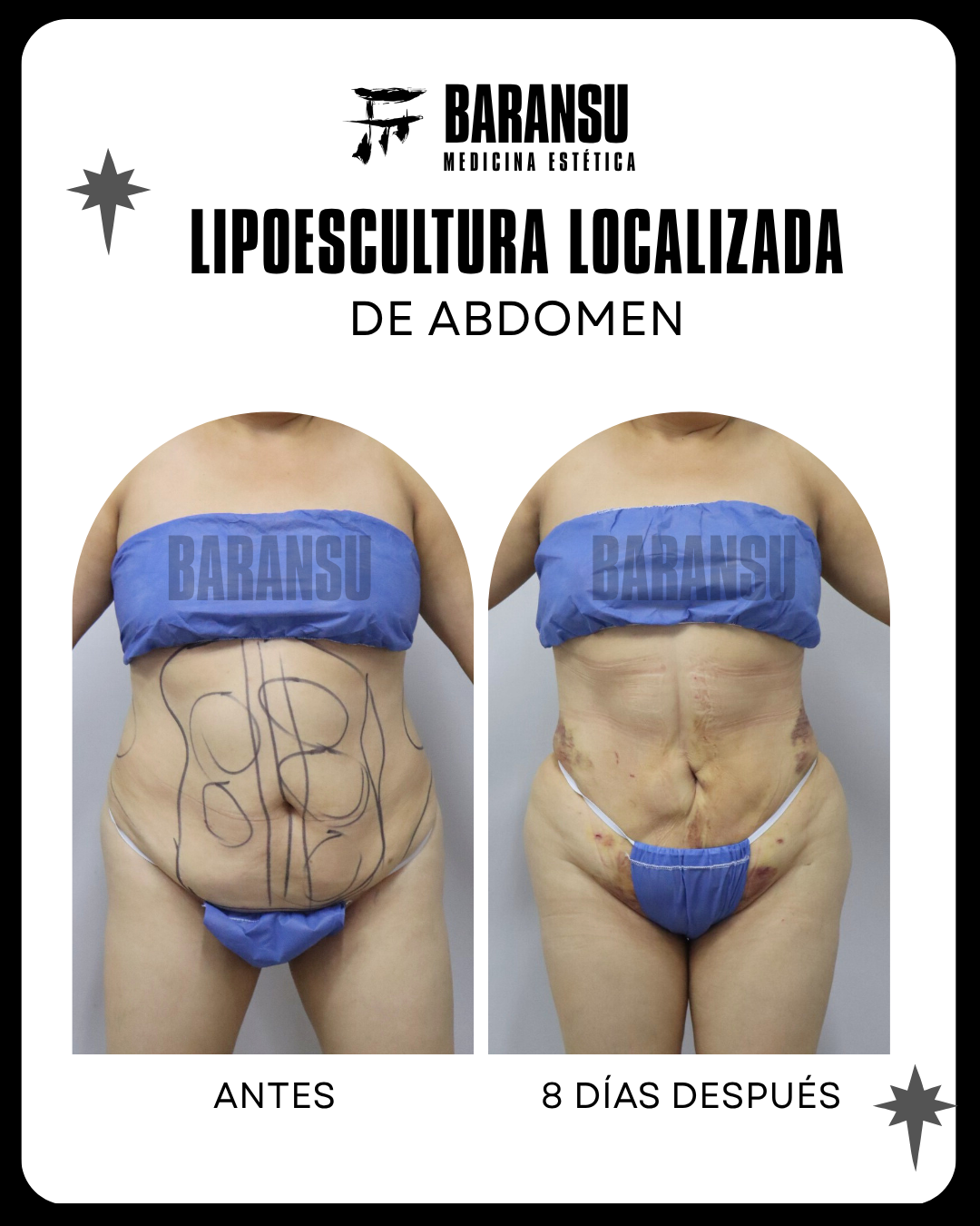lipoescultura localizada (minilipo) 55