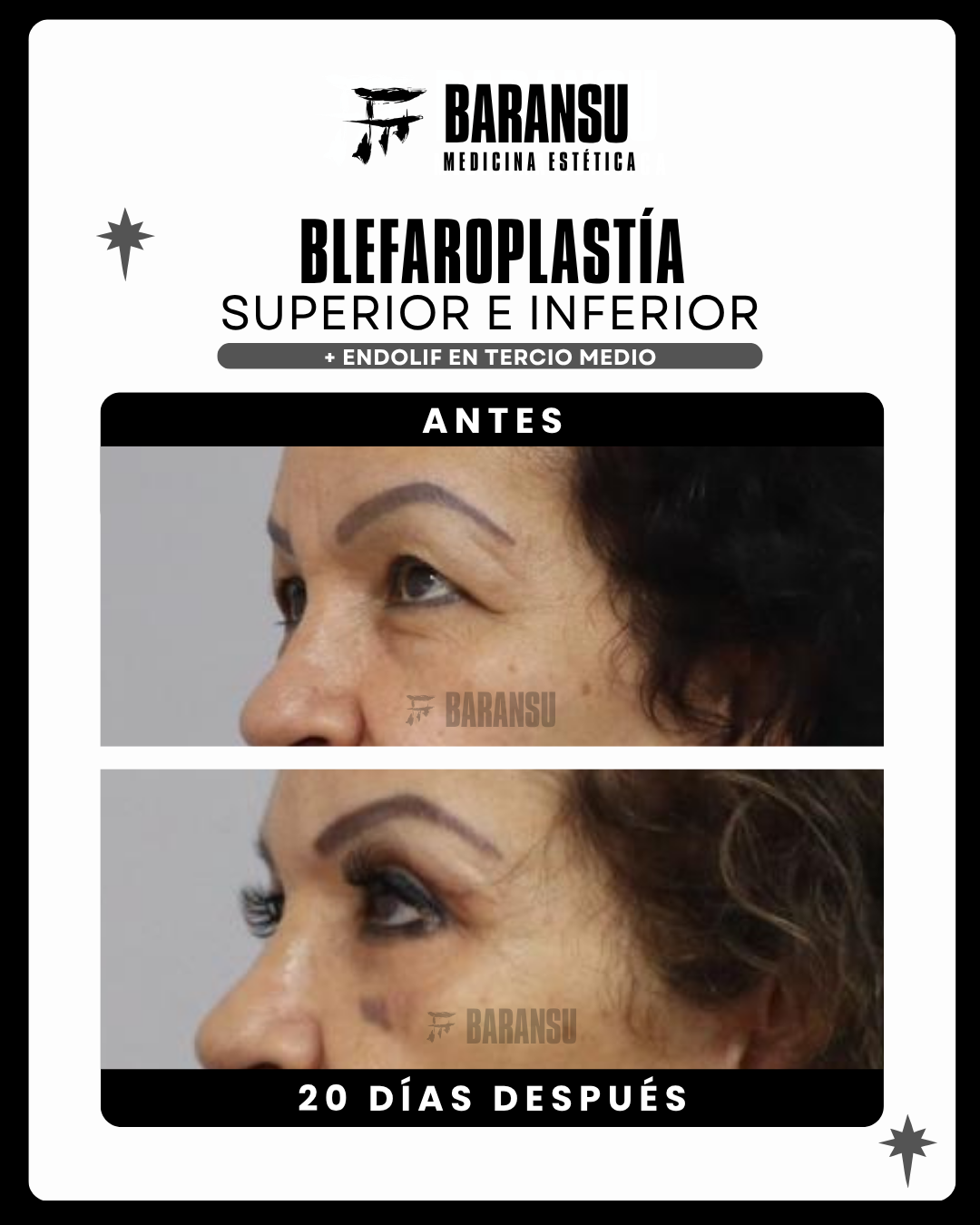 blefaroplastia 27