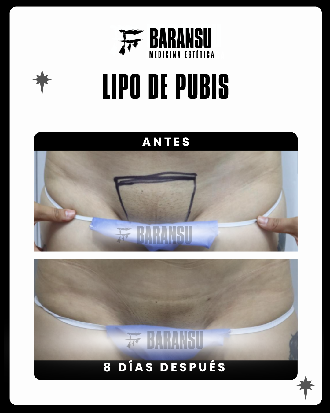 lipo de pubis 0