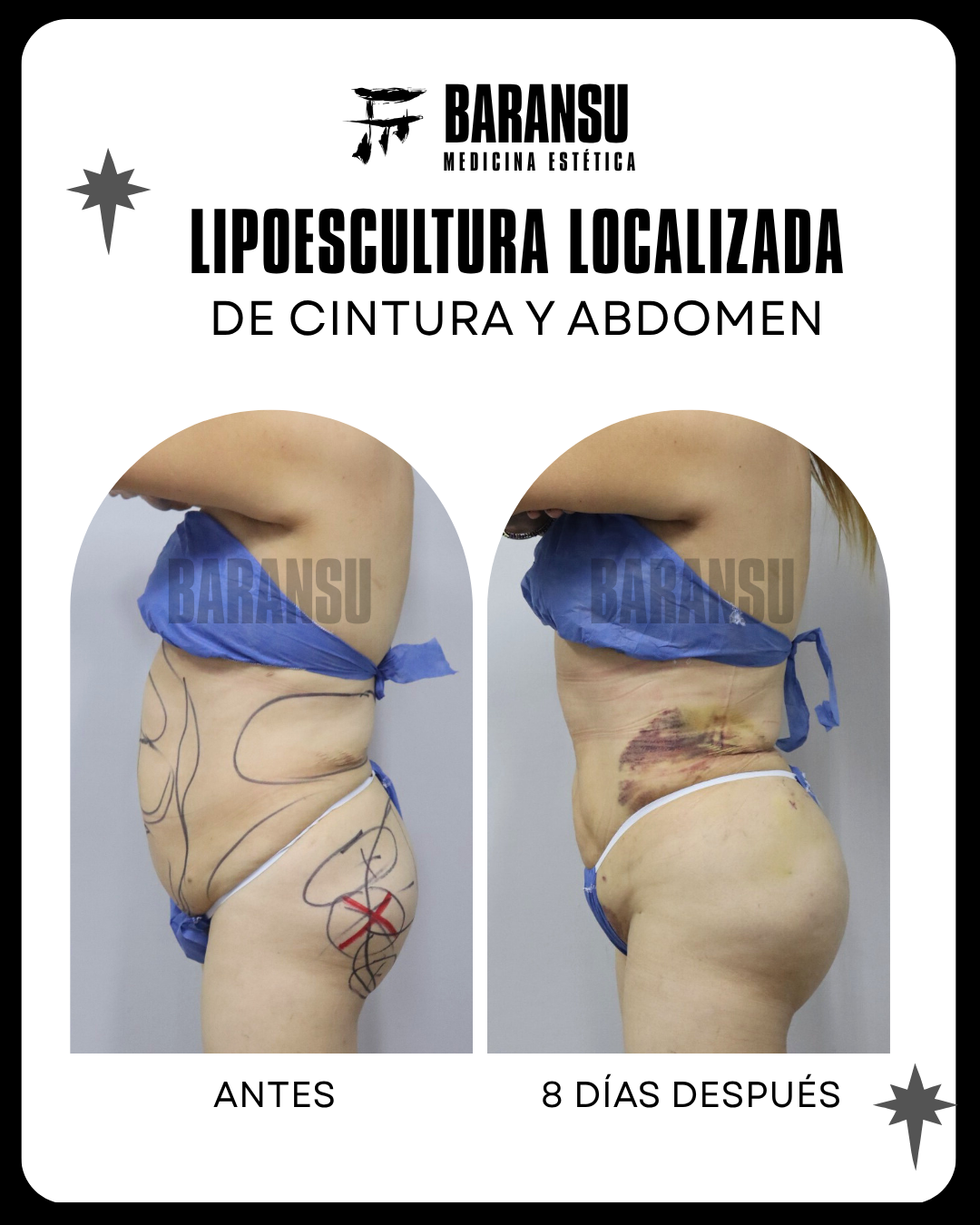 lipoescultura localizada (minilipo) 56