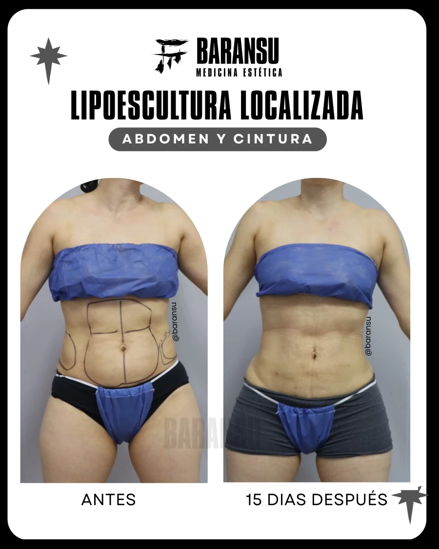 Lipoescultura Localizada (Minilipo) 56