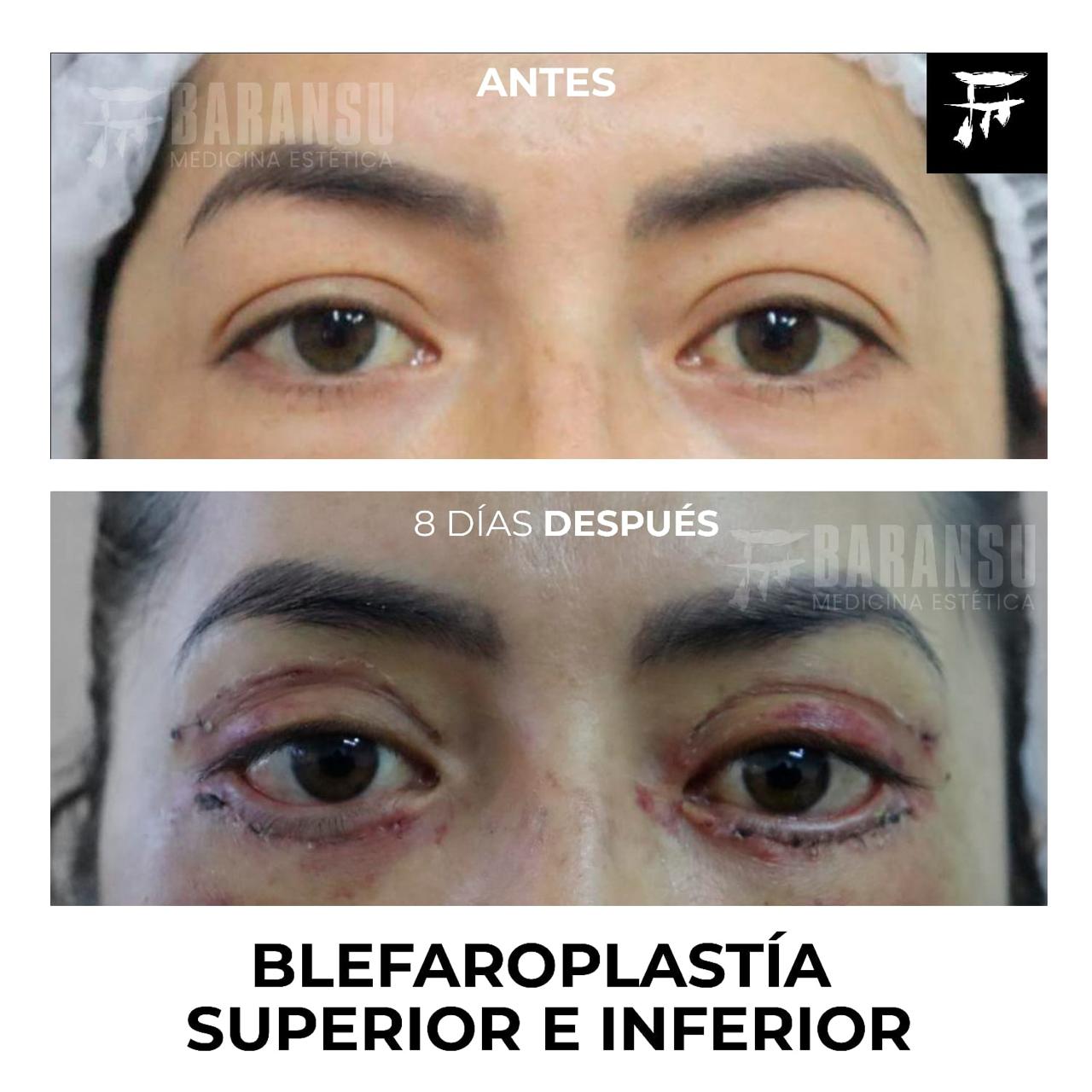 blefaroplastia 28