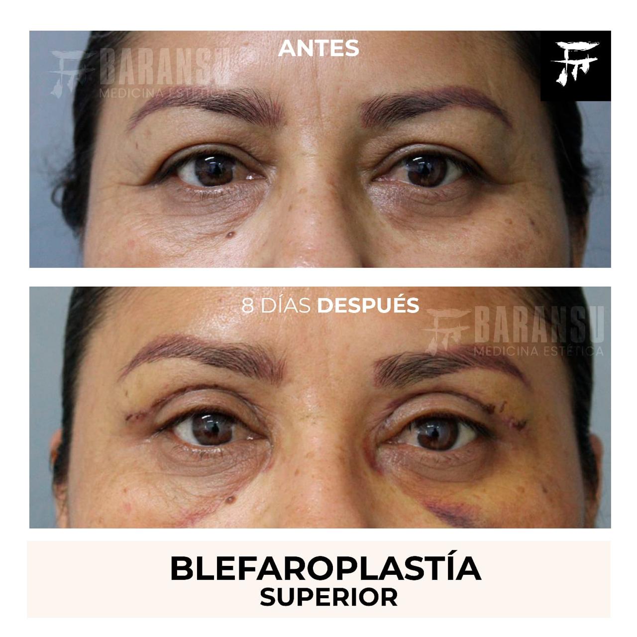 blefaroplastia 29