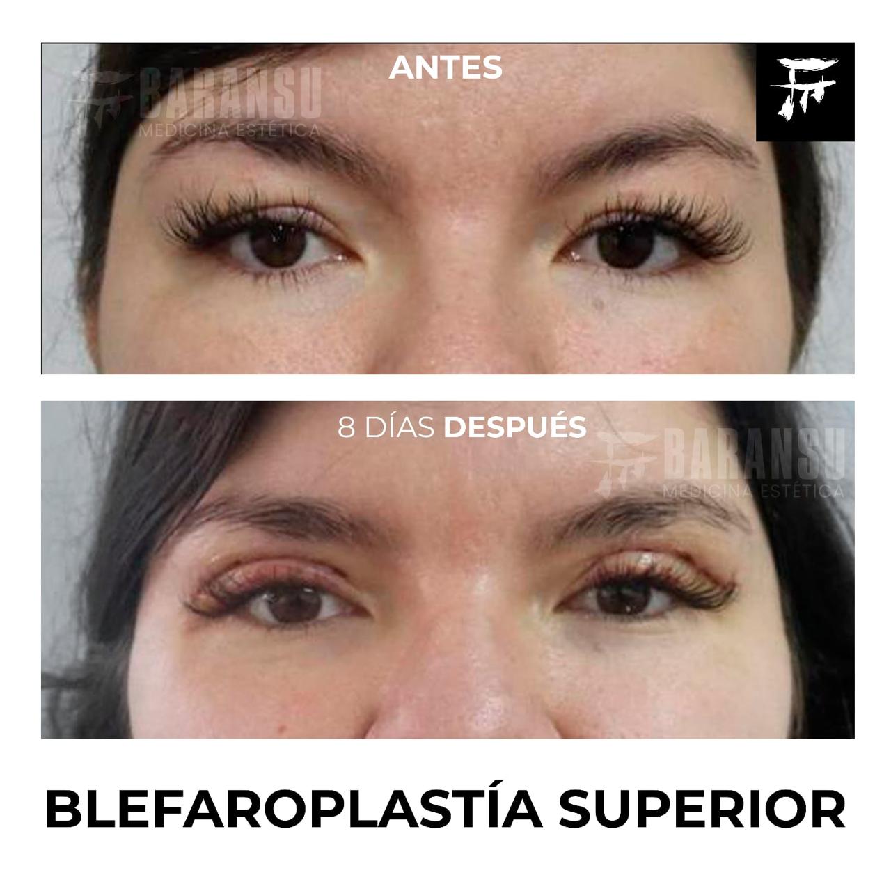 blefaroplastia 30