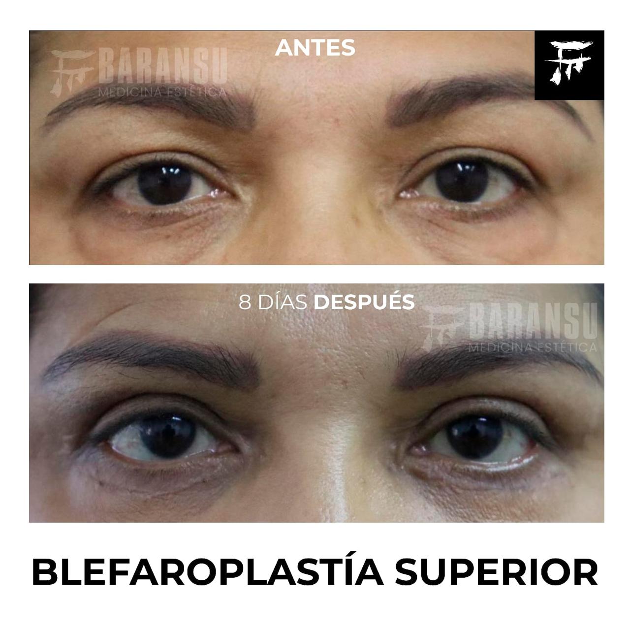 blefaroplastia 31