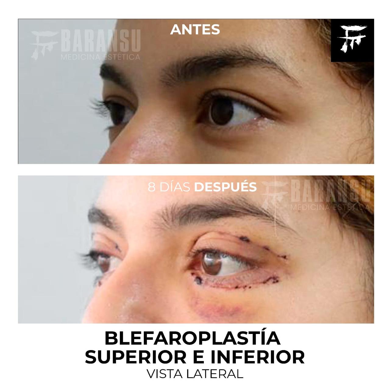 blefaroplastia 32