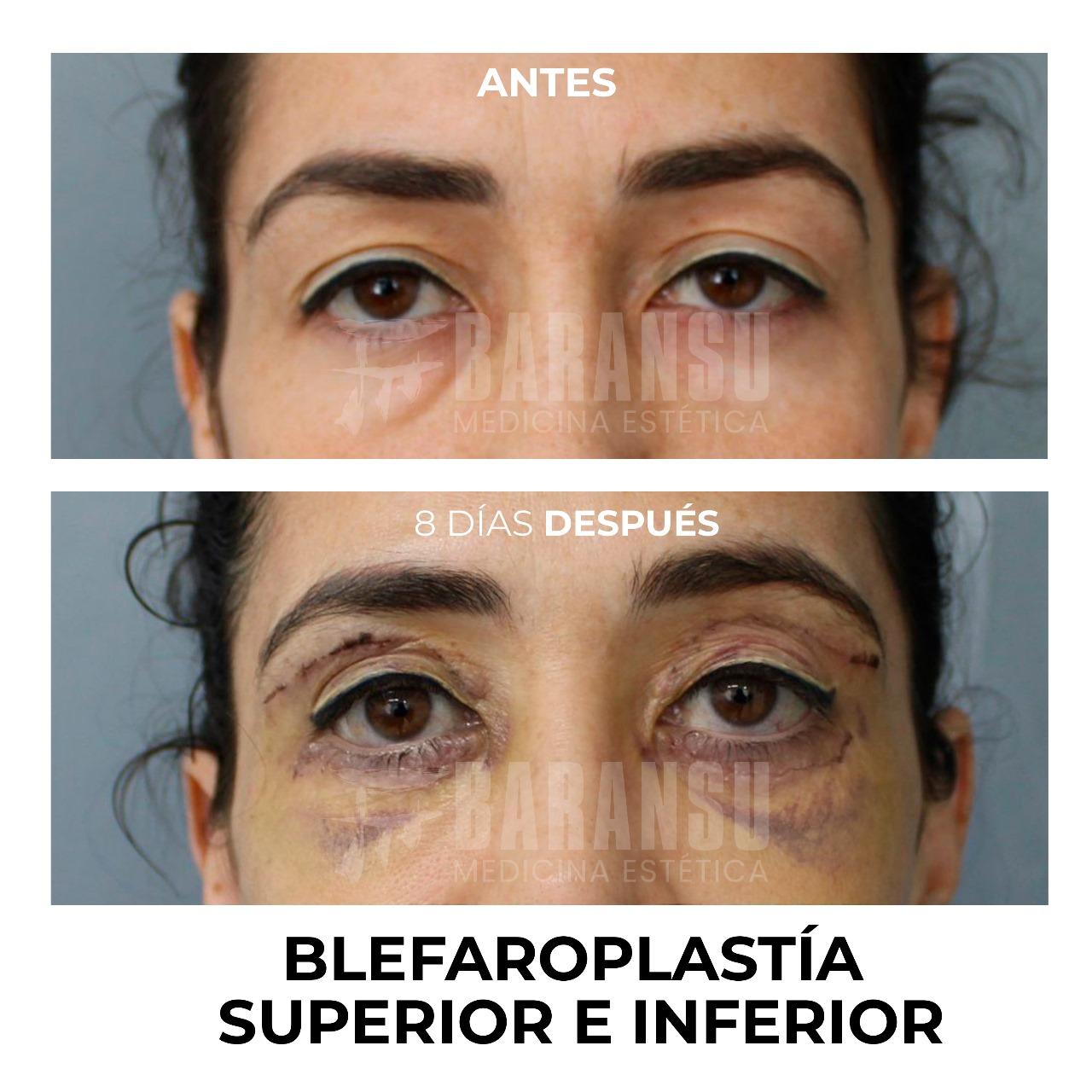 blefaroplastia 33