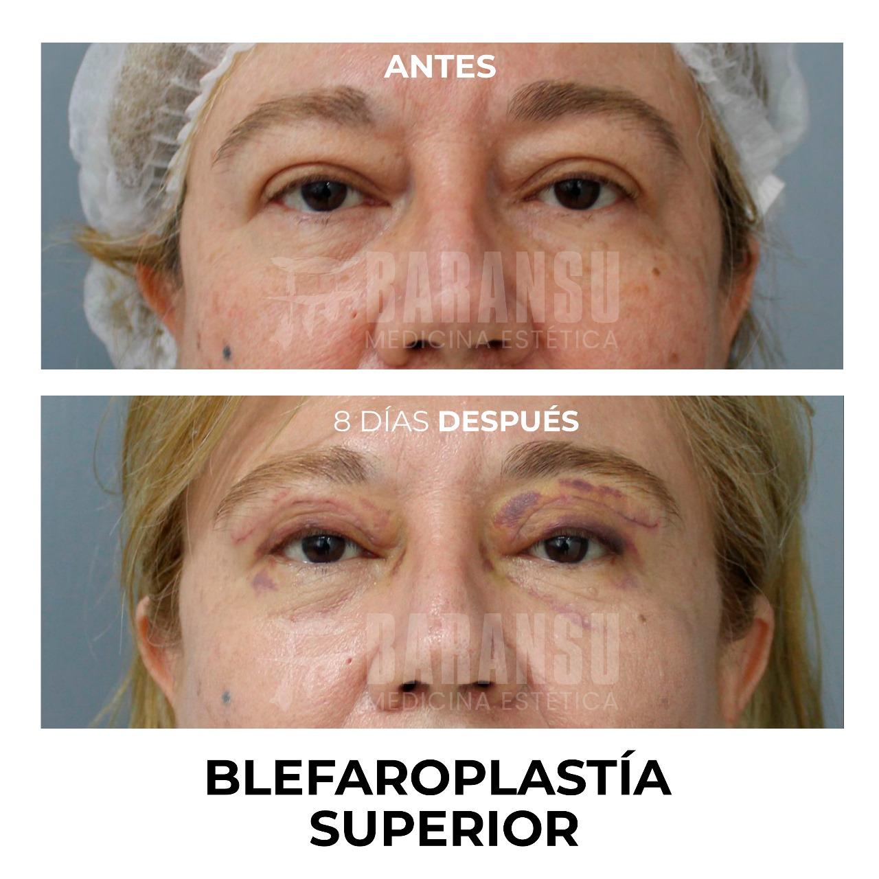 blefaroplastia 34